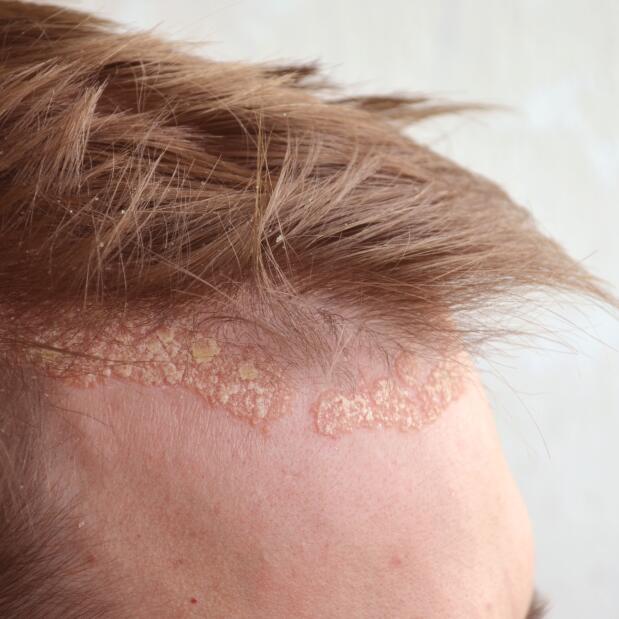 Tout savoir sur comment soigner le psoriasis.